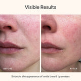 Close-up of mouth and lips skin before and after using Bare Intent’s reusable anti-wrinkle mouth & lip patch. Before shows visible smile lines and lip creases; after shows smoother, visibly plumper skin with reduced wrinkles.