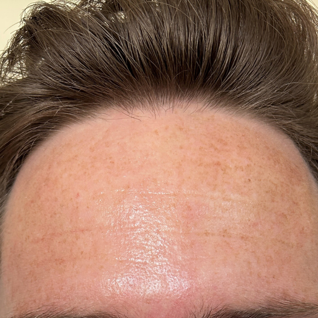 Close-up of chest skin before and after using Bare Intent’s reusable anti-wrinkle forehead patch. Before shows visible fine lines and creases across forehead; after shows smoother, visibly plumper skin with reduced wrinkles.