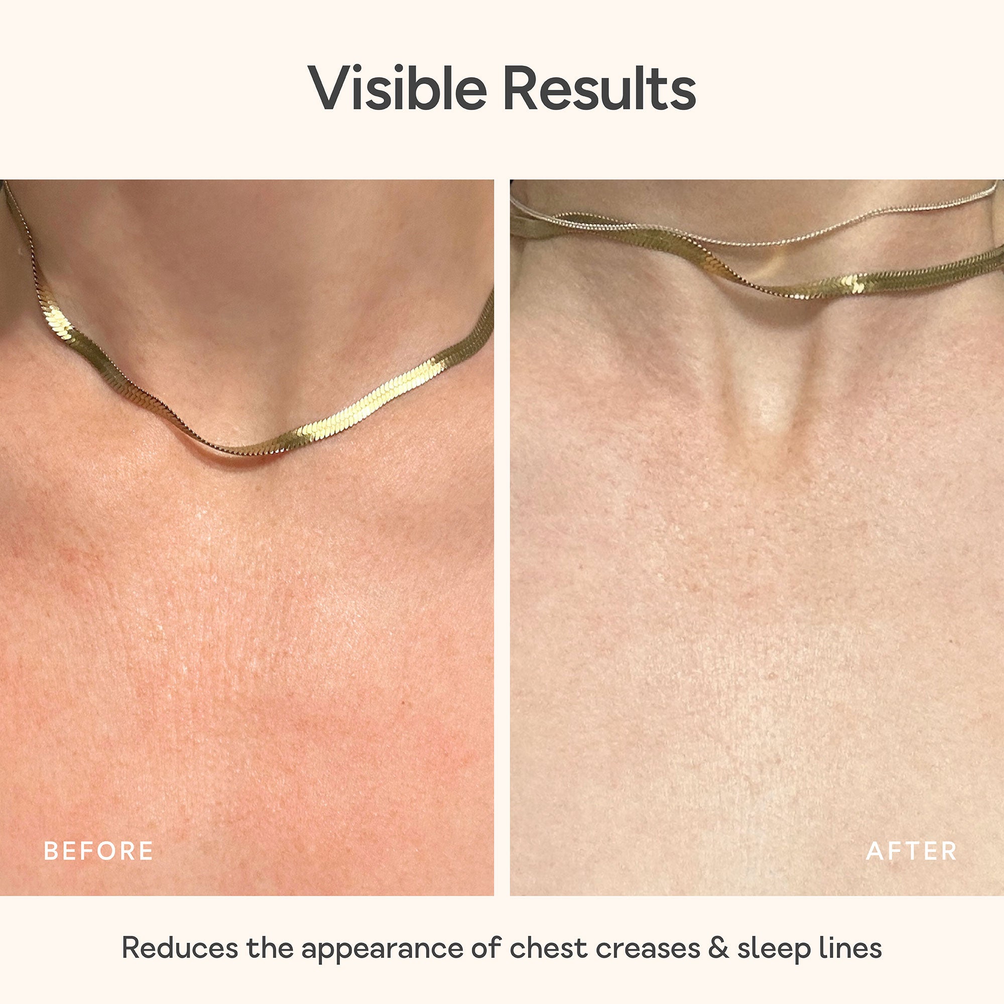 Close-up of chest skin before and after using Bare Intent’s reusable anti-wrinkle chest patch. Before shows visible fine lines and creases across décolleté; after shows smoother, visibly plumper skin with reduced wrinkles.