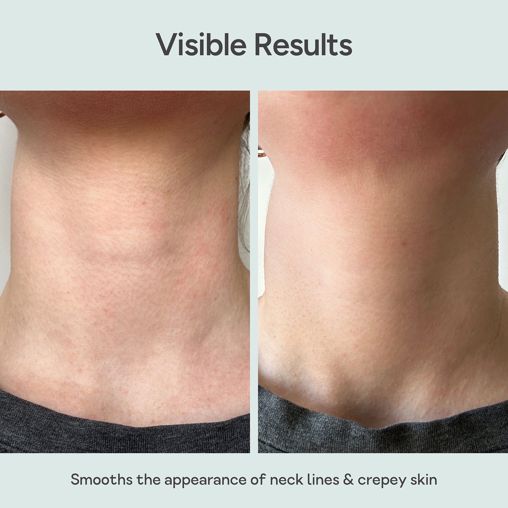 Before and after comparison of neck lines and crepey skin smoothing effect. Close-up of neck skin before and after using Bare Intent’s reusable anti-wrinkle neck patch. Before shows visible fine lines and creases across neck; after shows smoother, visibly plumper skin with reduced wrinkles.