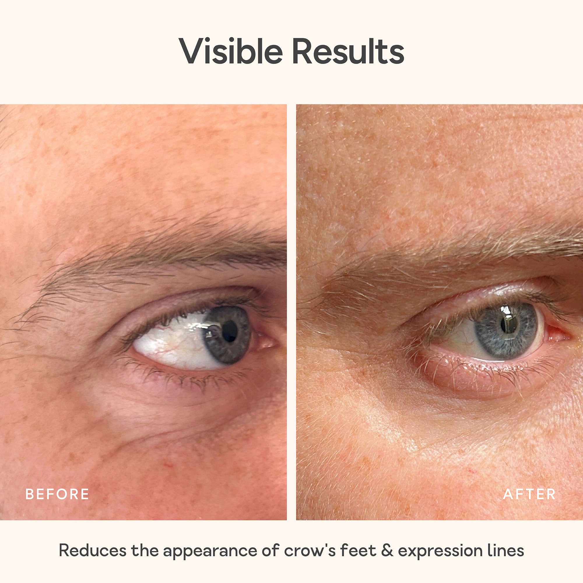 Before and after comparison of eye area with text indicating visible results. Close-up of eyes before and after using Bare Intent’s reusable anti-wrinkle eye patch. Before shows visible fine lines and crows feet; after shows smoother, visibly plumper skin with reduced wrinkles.