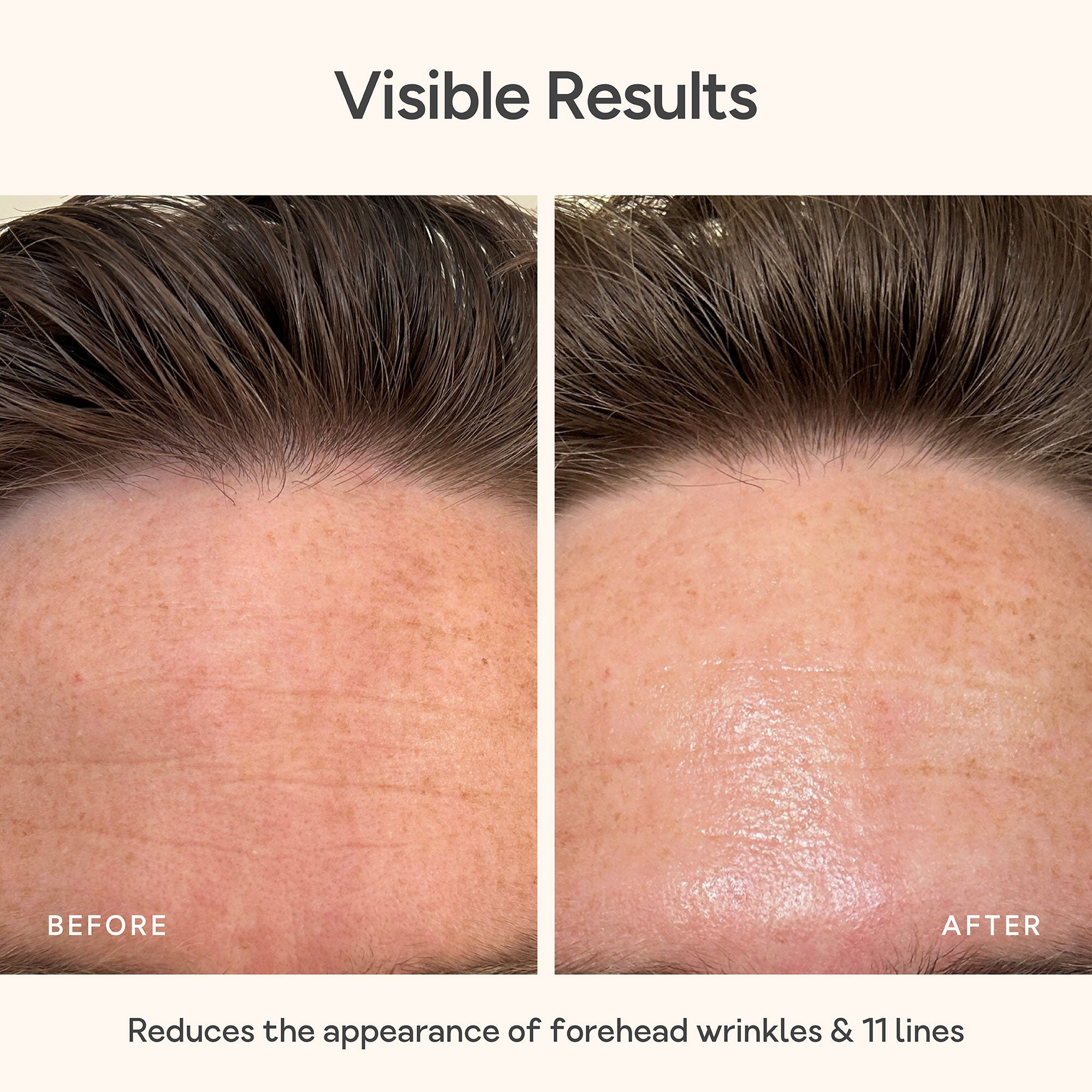 Before and after comparison of forehead wrinkles reduction treatment. Close-up of forehead skin before and after using Bare Intent’s reusable anti-wrinkle forehead patch. Before shows visible fine lines and wrinkles across forehead; after shows smoother, visibly plumper skin with reduced wrinkles.