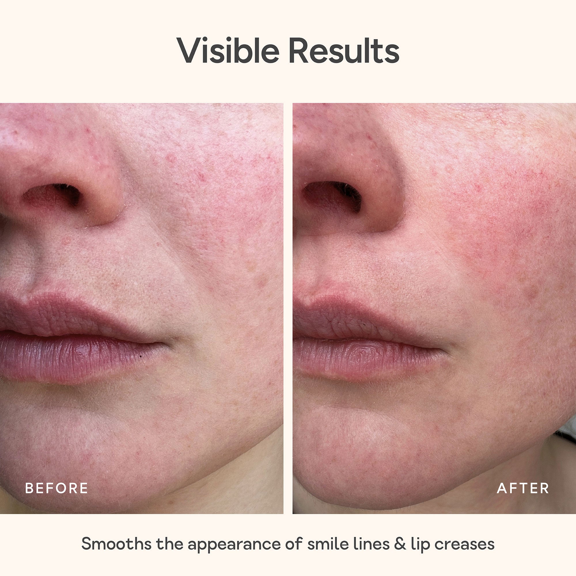 Close-up of mouth and lips skin before and after using Bare Intent’s reusable anti-wrinkle mouth & lip patch. Before shows visible smile lines and lip creases; after shows smoother, visibly plumper skin with reduced wrinkles.