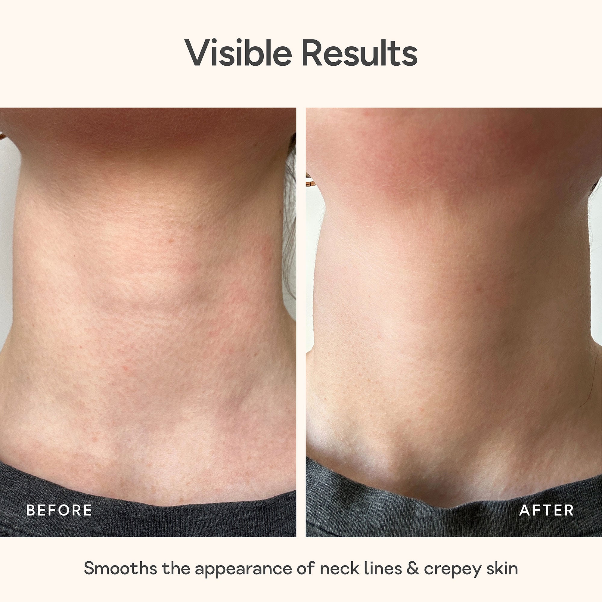 Before and after comparison of neck lines and crepey skin smoothing effect. Close-up of neck skin before and after using Bare Intent’s reusable anti-wrinkle neck patch. Before shows visible fine lines and creases across neck; after shows smoother, visibly plumper skin with reduced wrinkles.