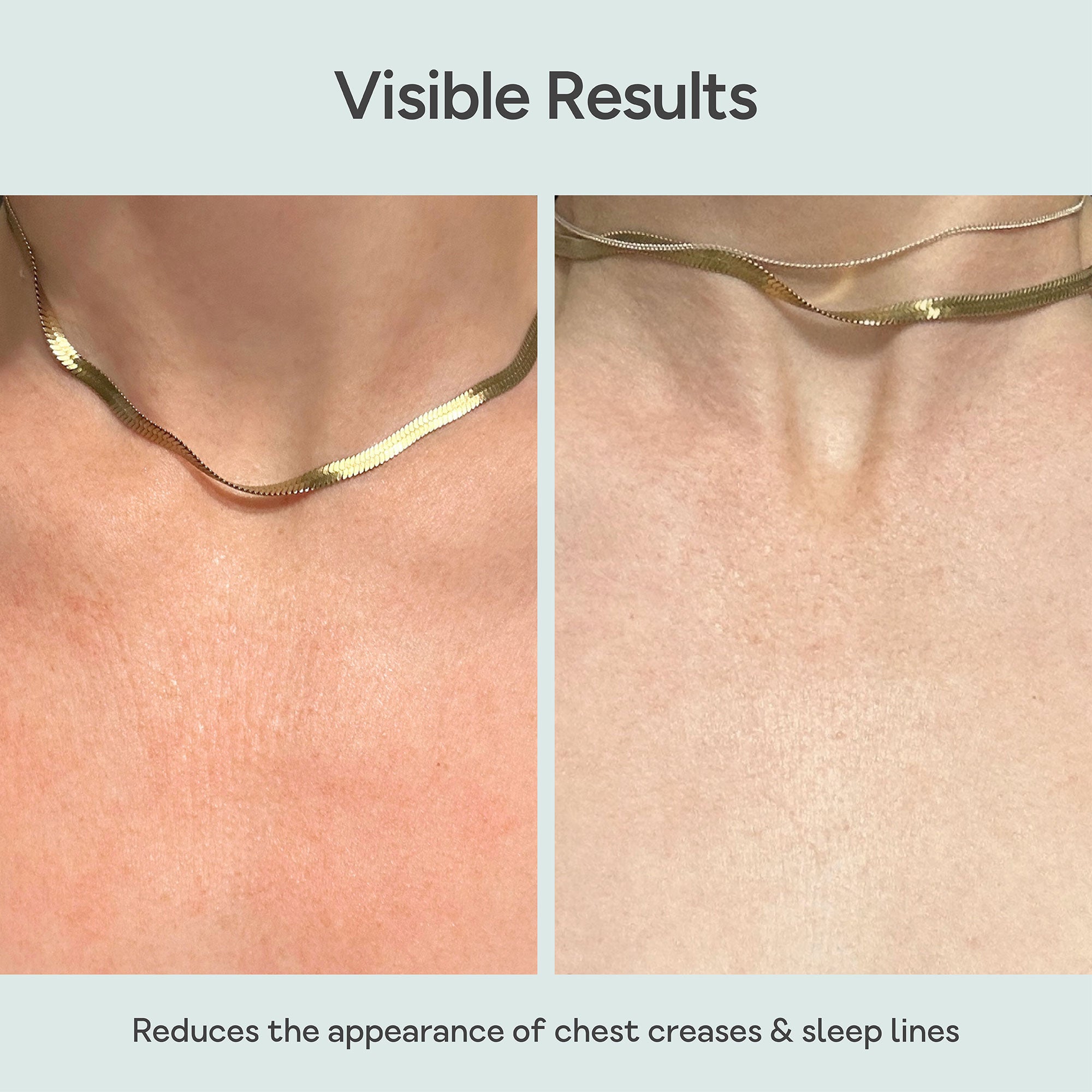 Close-up of chest skin before and after using Bare Intent’s reusable anti-wrinkle chest patch. Before shows visible fine lines and creases across décolleté; after shows smoother, visibly plumper skin with reduced wrinkles.