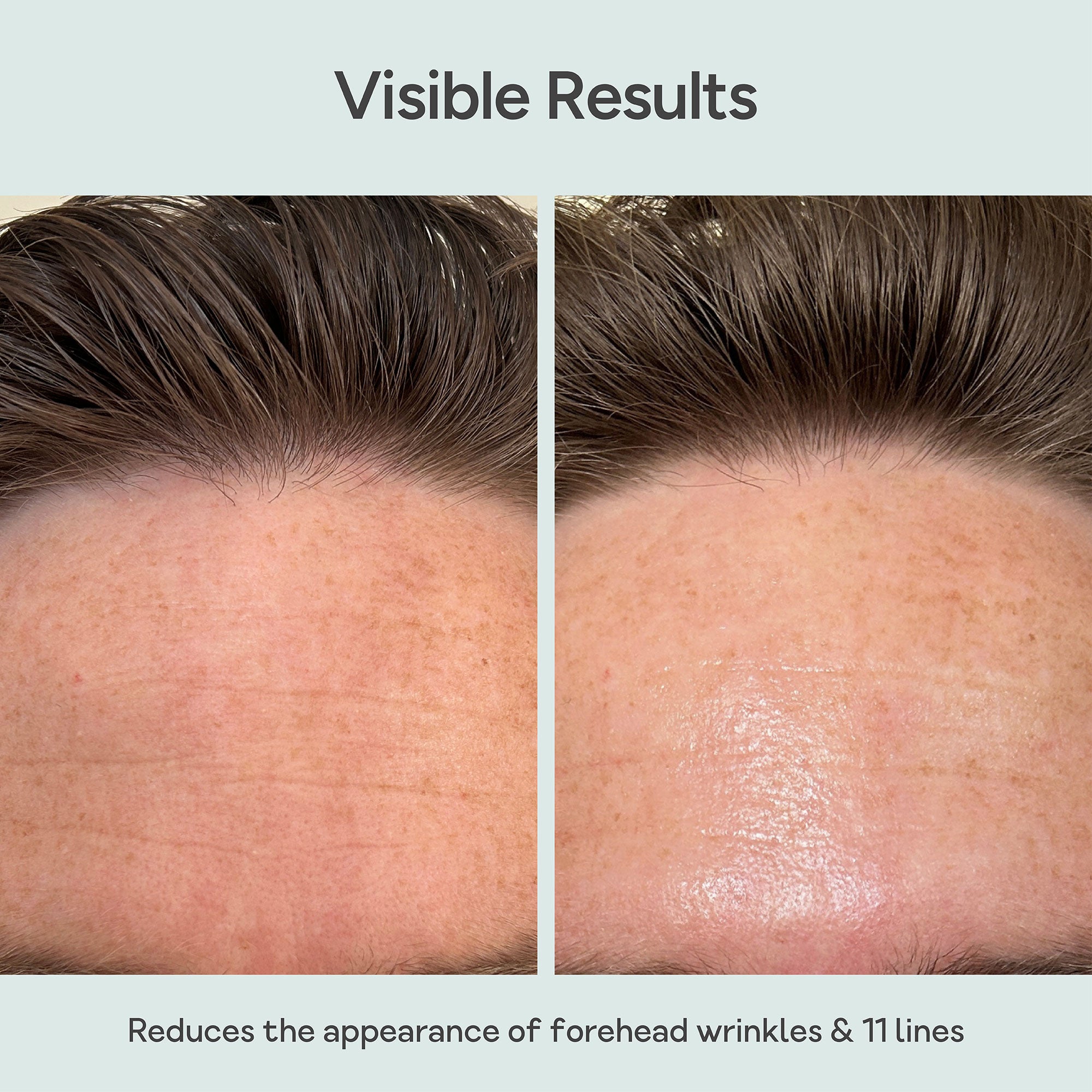 Before and after comparison of forehead wrinkles reduction treatment. Close-up of forehead skin before and after using Bare Intent’s reusable anti-wrinkle forehead patch. Before shows visible fine lines and wrinkles across forehead; after shows smoother, visibly plumper skin with reduced wrinkles.