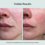 Close-up of mouth and lips skin before and after using Bare Intent’s reusable anti-wrinkle mouth & lip patch. Before shows visible smile lines and lip creases; after shows smoother, visibly plumper skin with reduced wrinkles.