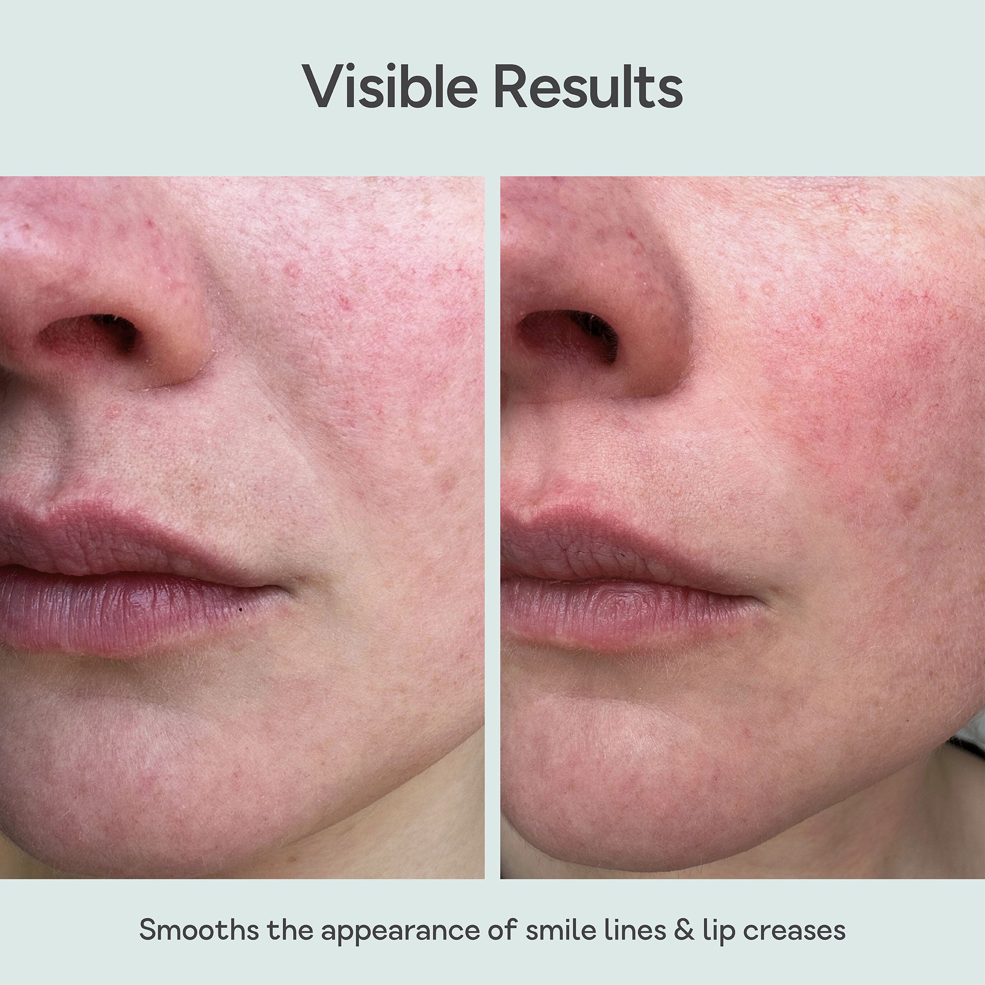 Close-up of mouth and lips skin before and after using Bare Intent’s reusable anti-wrinkle mouth & lip patch. Before shows visible smile lines and lip creases; after shows smoother, visibly plumper skin with reduced wrinkles.