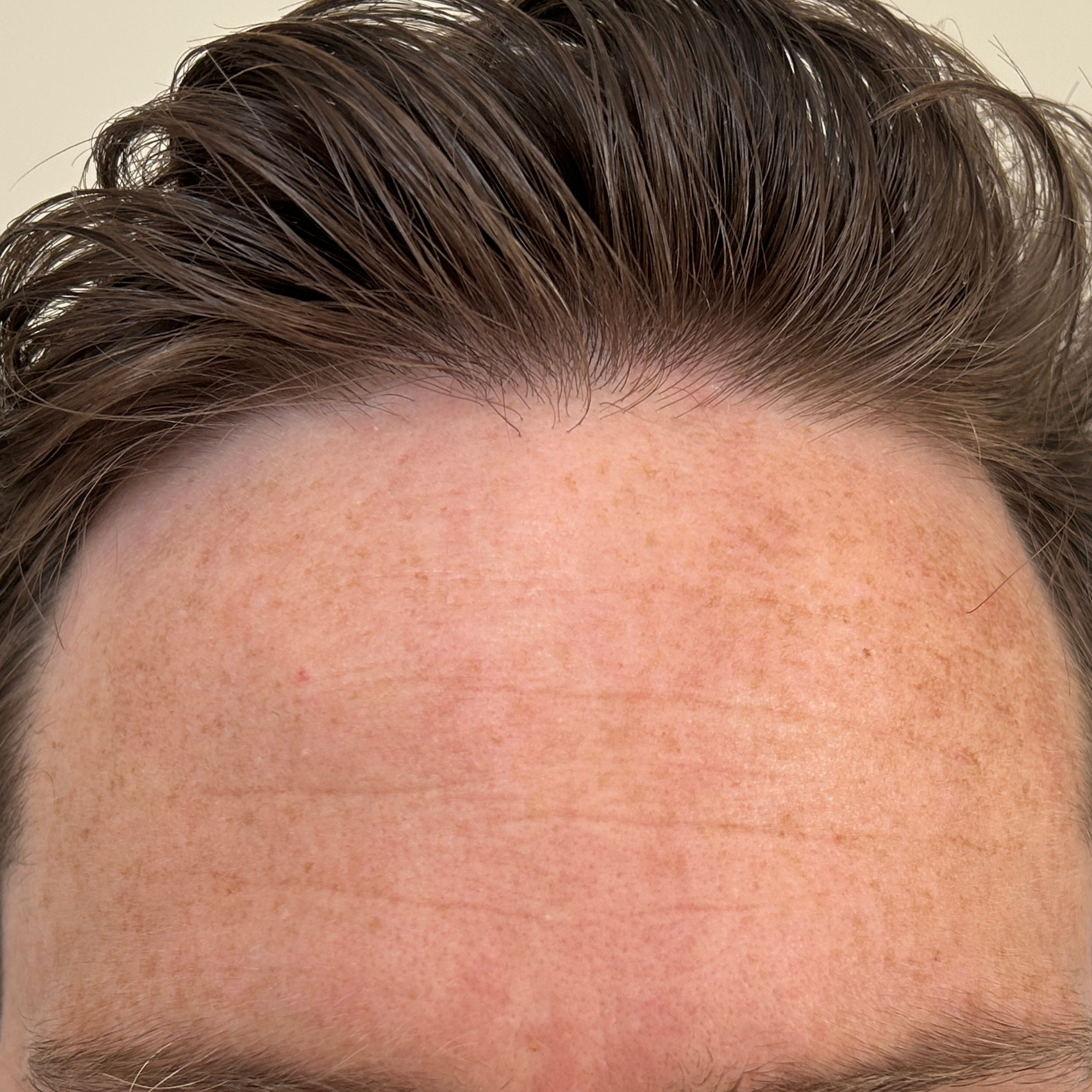Close-up of chest skin before and after using Bare Intent’s reusable anti-wrinkle forehead patch. Before shows visible fine lines and creases across forehead; after shows smoother, visibly plumper skin with reduced wrinkles.