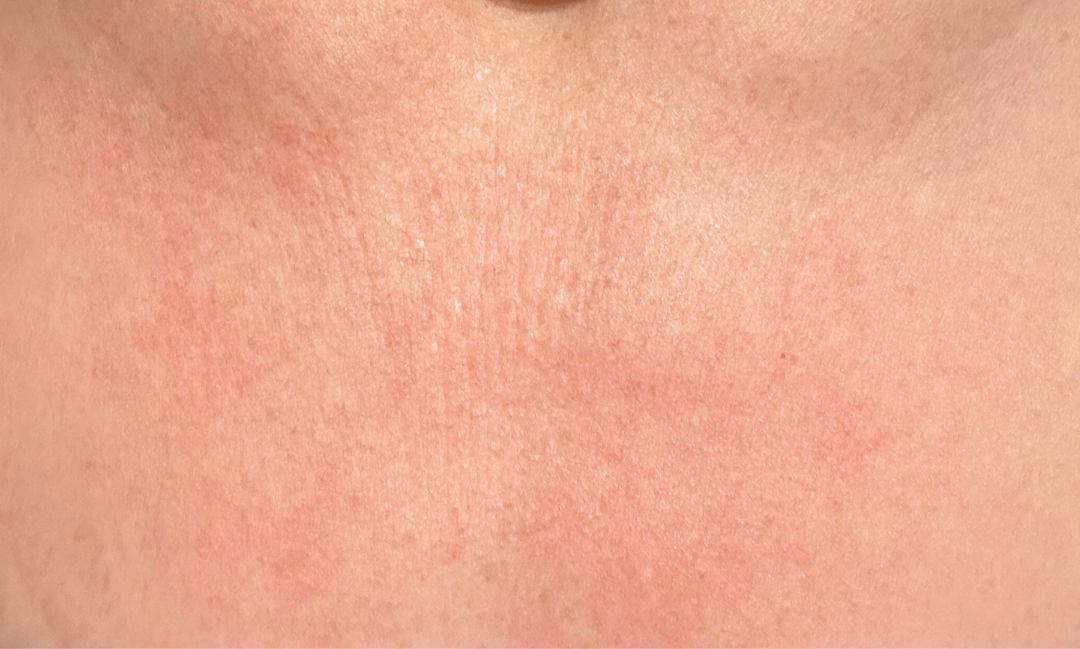 Close-up of chest skin before and after using Bare Intent’s reusable anti-wrinkle chest patch. Before shows visible fine lines and creases across décolleté; after shows smoother, visibly plumper skin with reduced wrinkles.